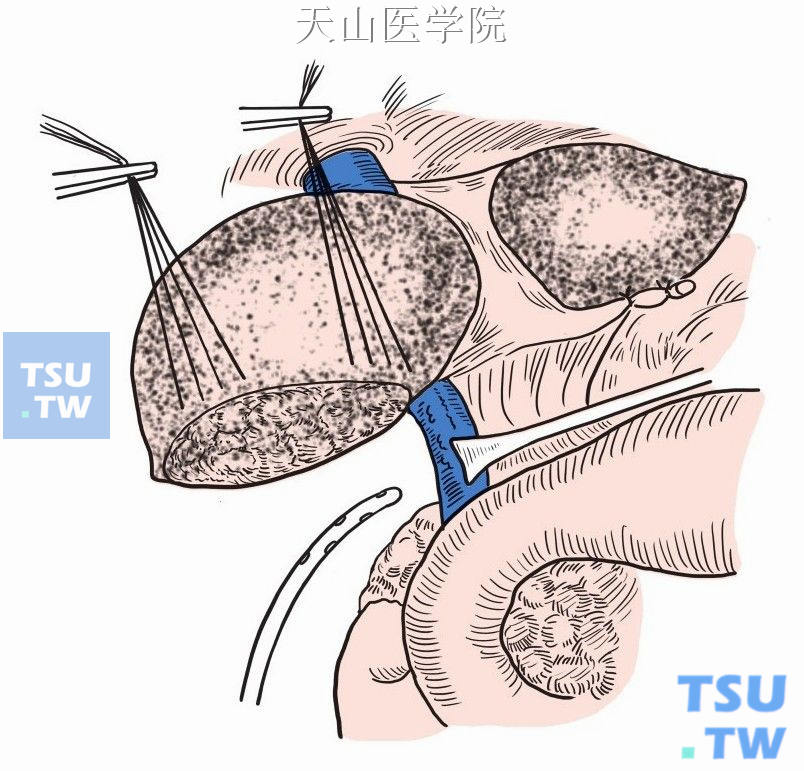 在右膈下或肿瘤切除后遗留的空腔内放置乳胶管引流