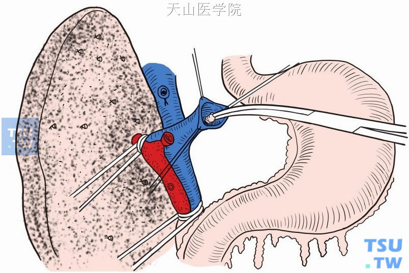 用取石钳取除门静脉内癌栓