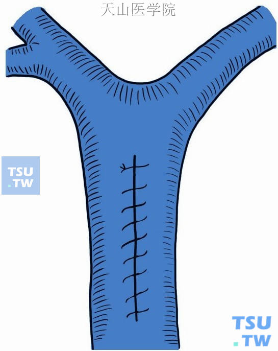 用5-0无创伤血管缝线缝闭门静脉主干切口