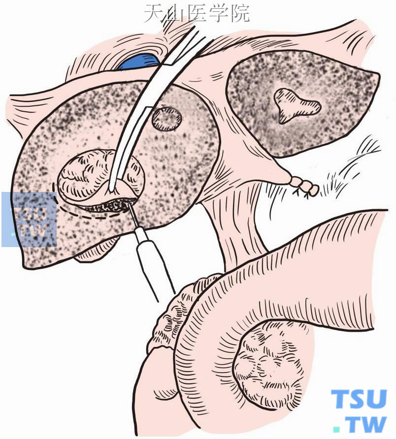 肝囊肿开窗引流术