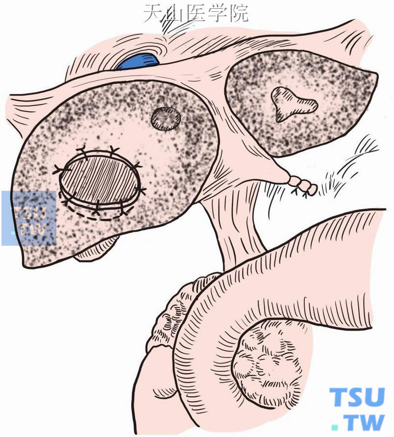 外翻缝合囊肿壁，敞开囊腔