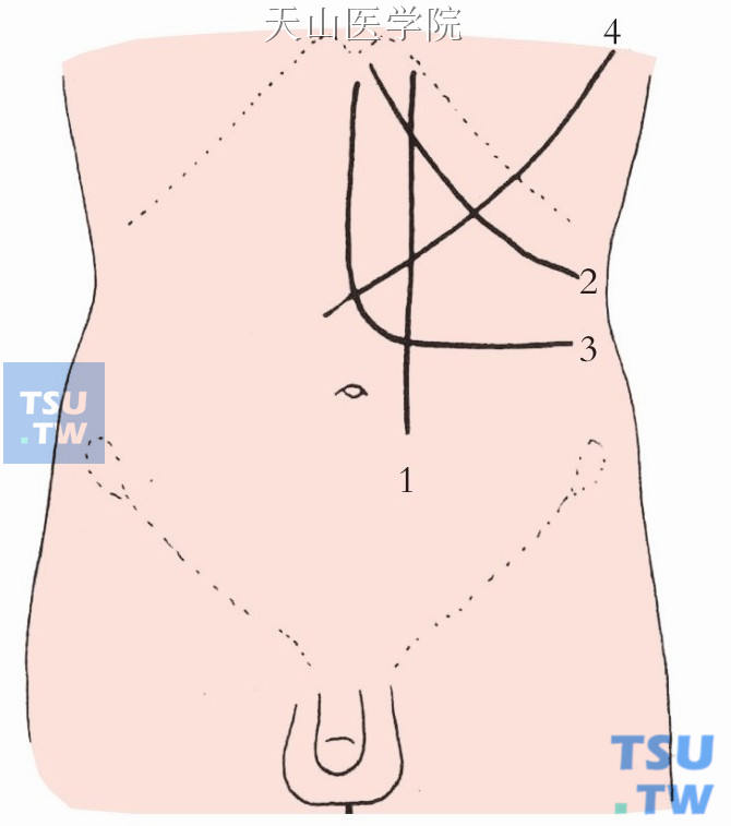常取左上腹经腹直肌切口或左肋缘下斜切口，也可选用左肋缘下“L”形切口或左侧胸腹联合切口