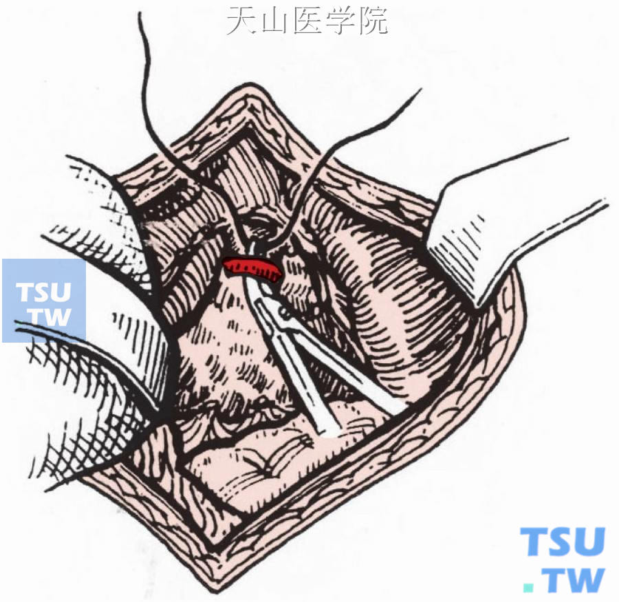 带线结扎脾动脉