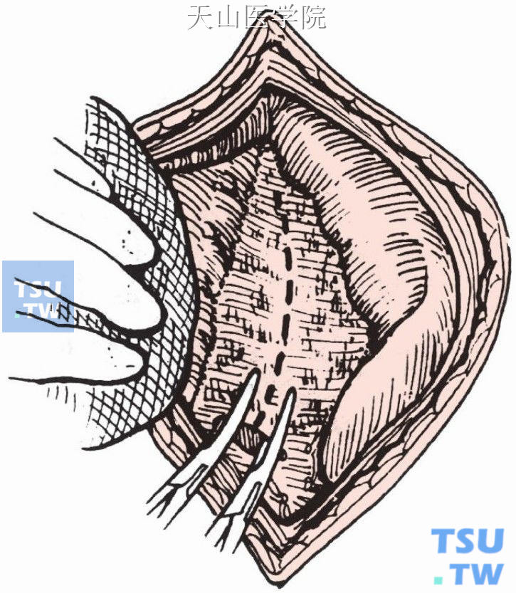 离断脾胃韧带