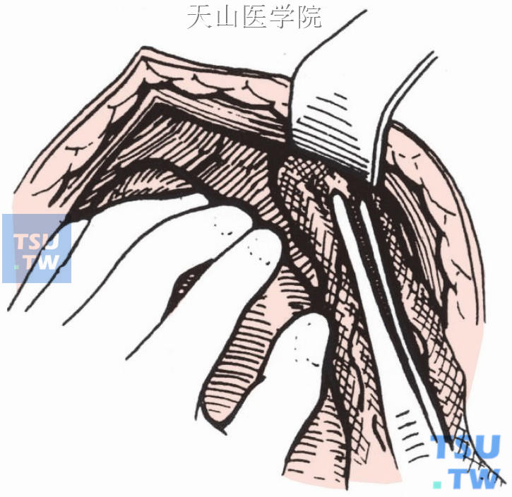 脾脏后方填以纱布垫