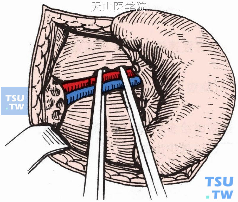 钳夹脾动、静脉
