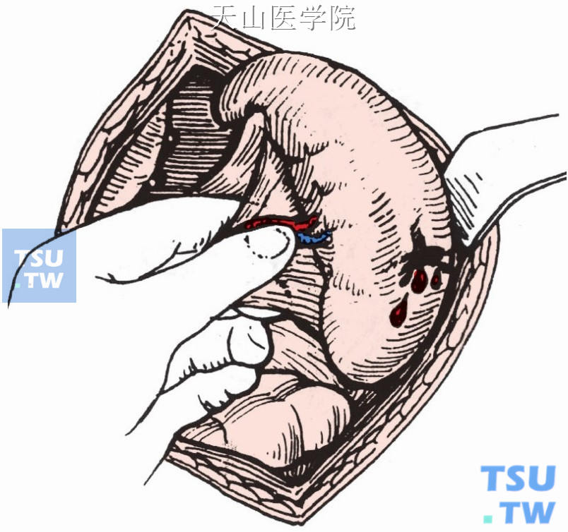 捏住脾蒂，控制出血