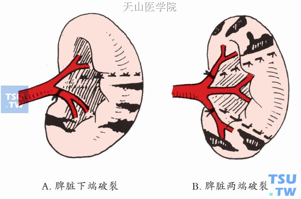 结扎相应切除区域的血管