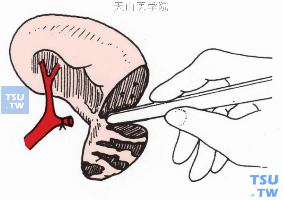 切开脾包膜