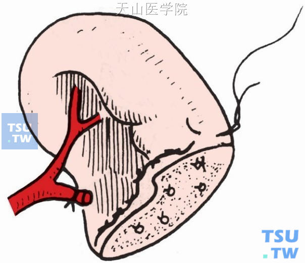 脾脏断面结扎或“U”形交锁缝合