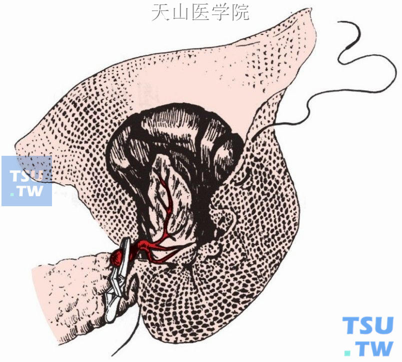 将裂伤的脾脏套入网中