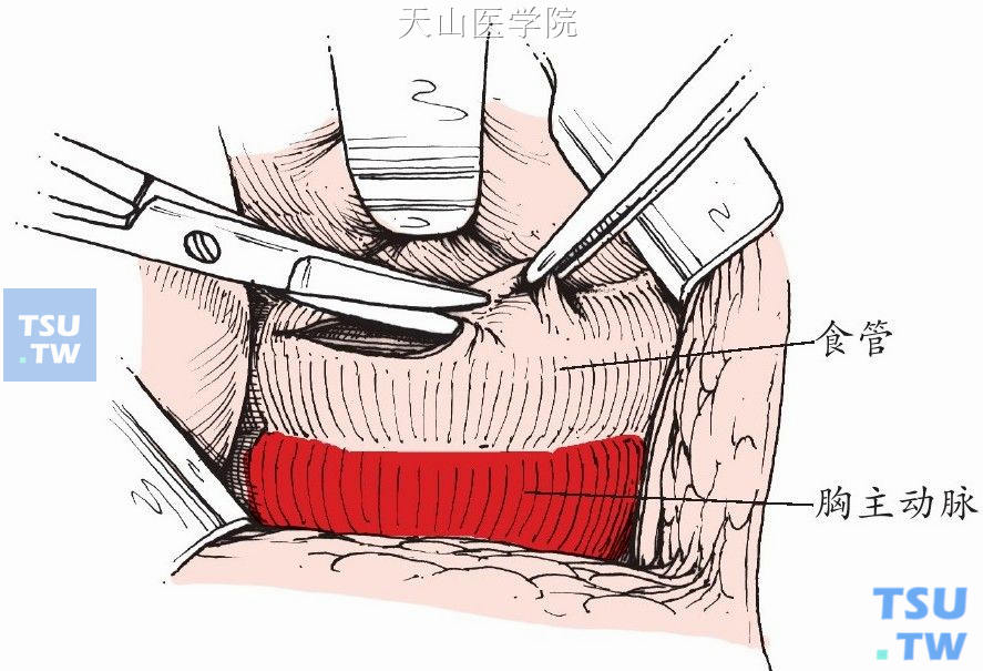 剪开食管表面纵隔壁