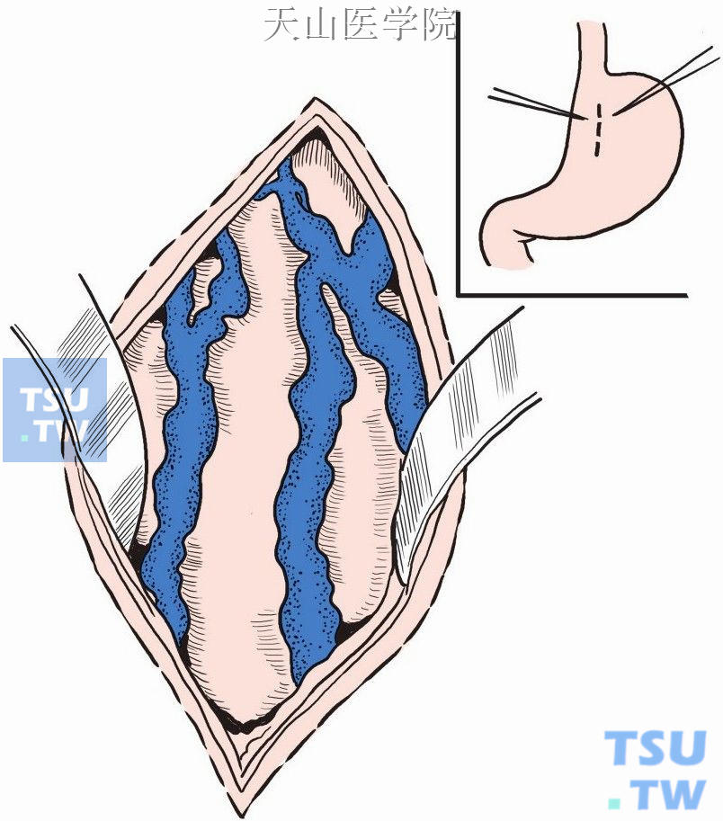 切开胃壁，显露静脉曲张和出血点