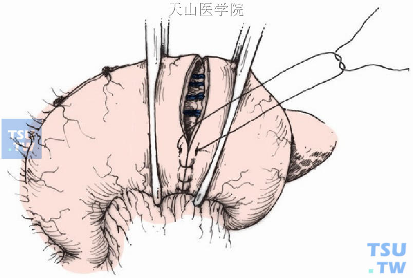 经腹胃粘膜下血管缝扎术