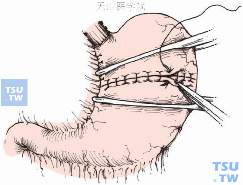 间断缝合胃前壁浆肌层