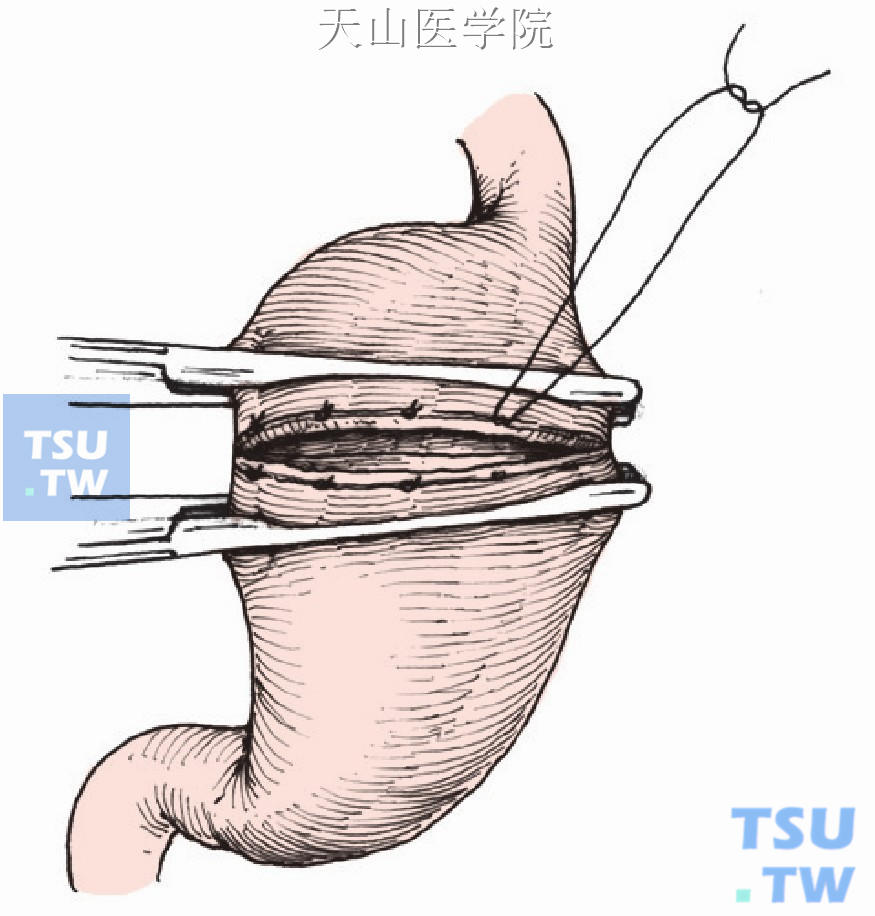结扎胃后壁粘膜下血管，吻合胃后壁