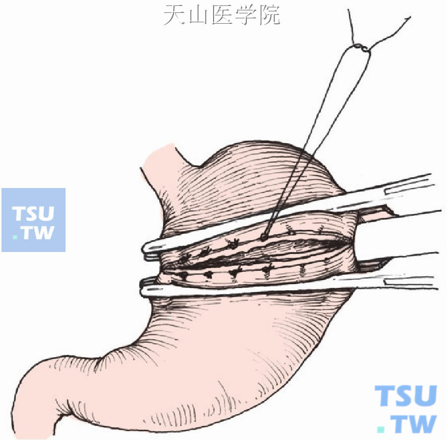 腹腔镜胃底折叠术图片