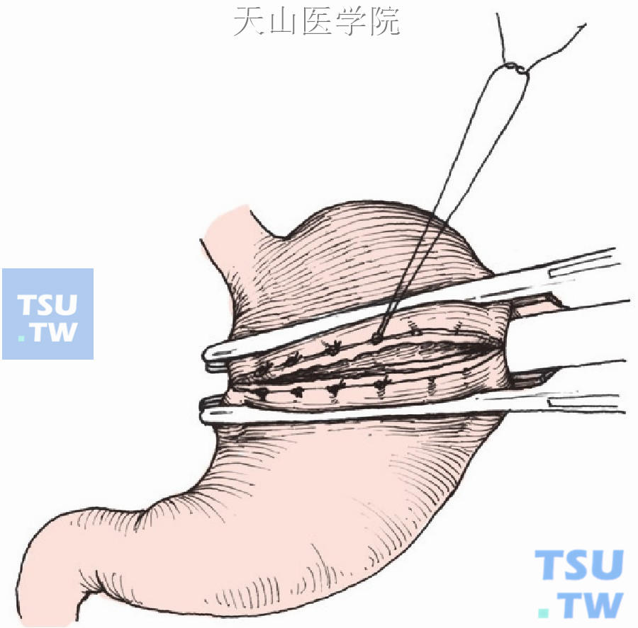 结扎胃前壁粘膜下血管，缝合前壁
