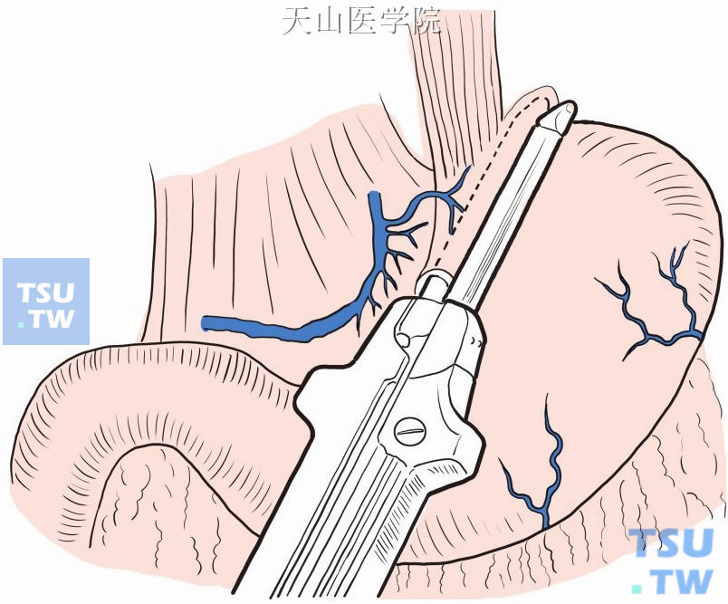 用直线型切割吻合器行胃底浆膜内外缝扎术