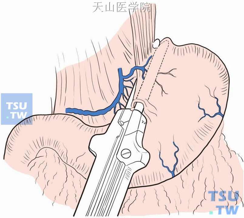 后壁缝合