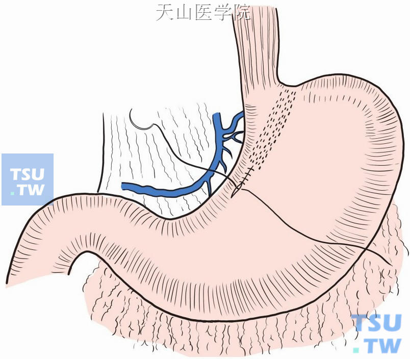 缝合胃小弯切口