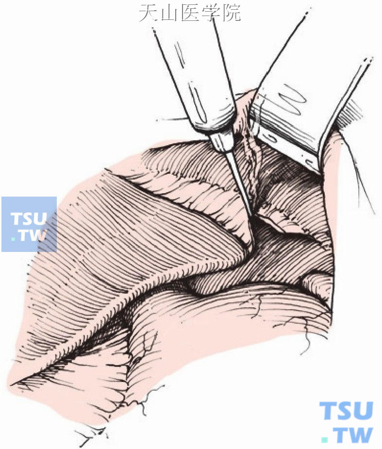 切开肝左三角韧带