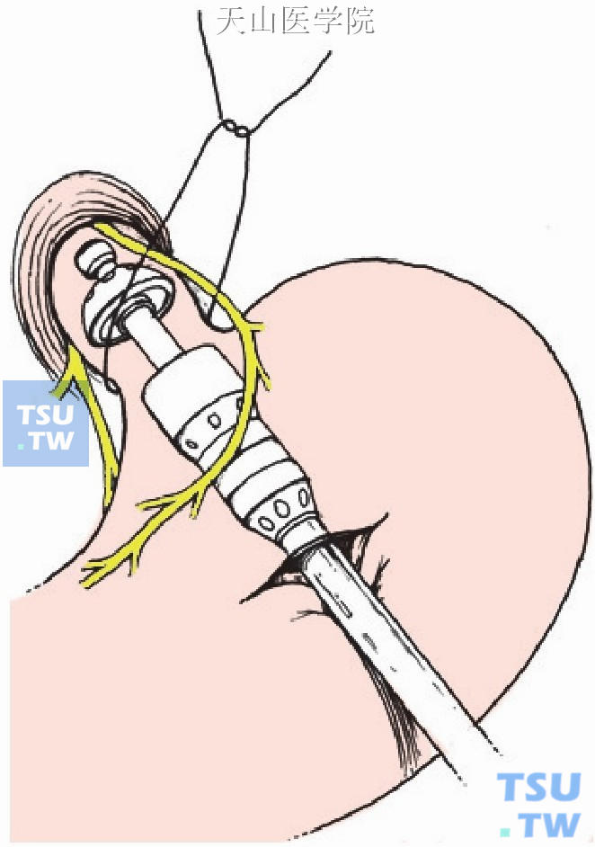 用管型吻合器行食管下端横断术，其间注意保护迷走神经