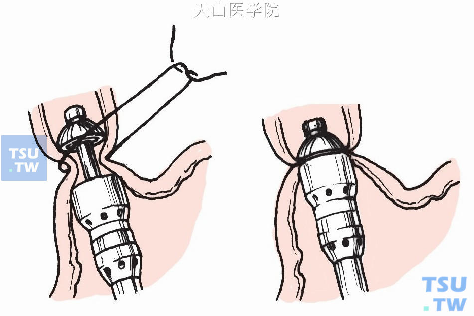 经腹食管下端横断术（用胃肠吻合器行食管下端横断术）