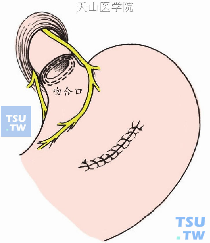 缝合胃前壁的切口