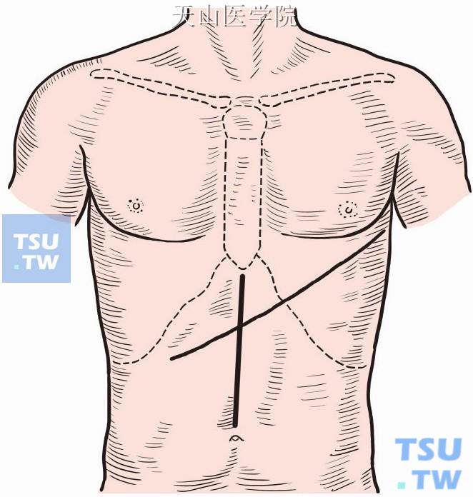 取上腹正中或旁正中切口，若合并开胸，取右侧卧位胸腹联合切口，经左侧胸第7或8肋间，前端需切断肋弓，后端达腋中线