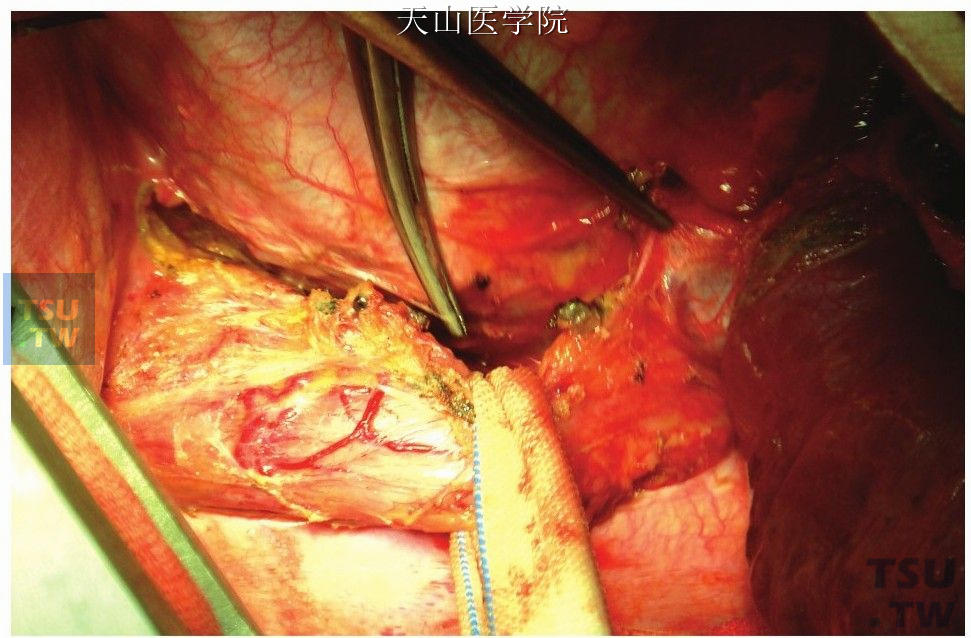 显露并游离食管下端，在左肺下静脉水平面游离食管