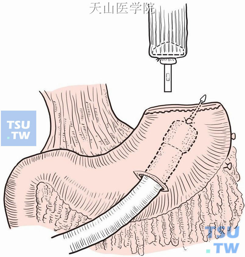 吻合器行胃前壁食管下端吻合