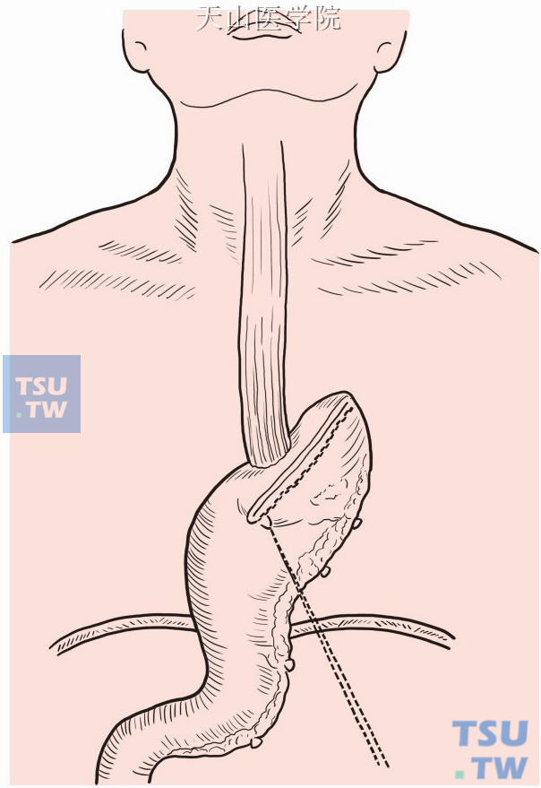 将残留的膈食管腹膜缝合于胃残端，覆盖吻合口