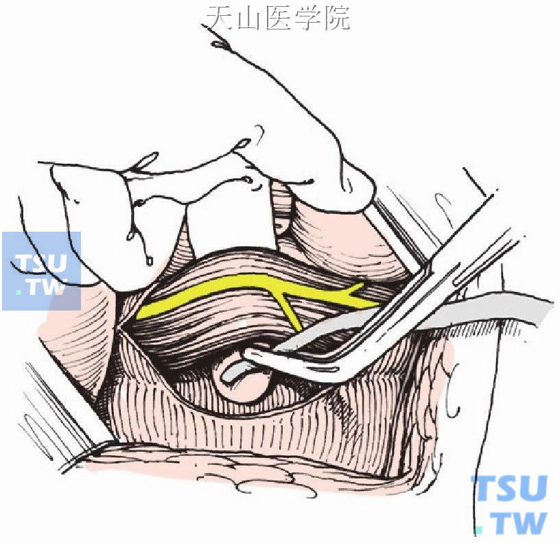 游离食管下端