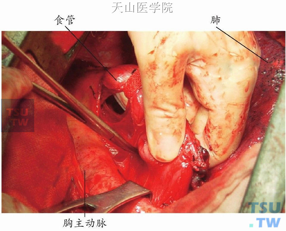 食管下段游离达主动脉弓下