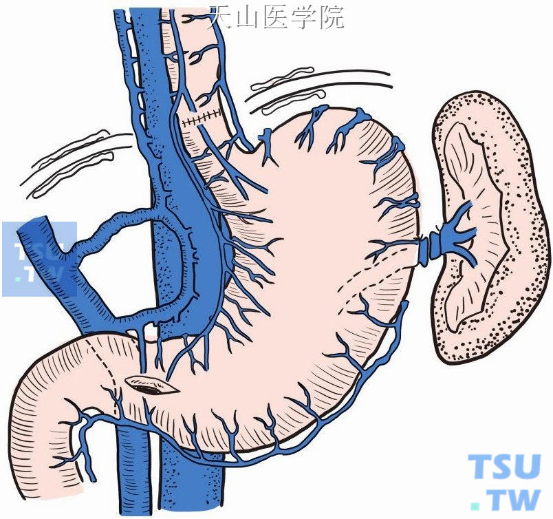 食管下段、胃底、胃体近侧完全游离