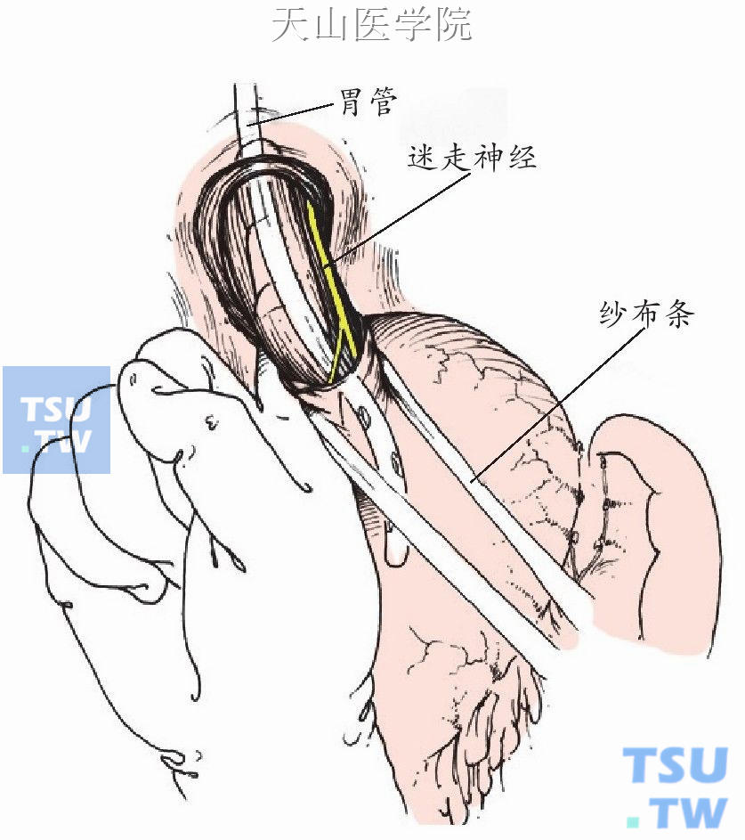 游离食管下段后壁