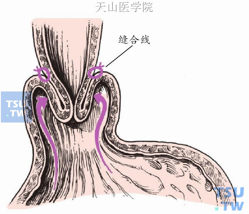 将胃底部胃壁的浆肌层间断缝合包绕食管下段和贲门，将其部分包埋在其中