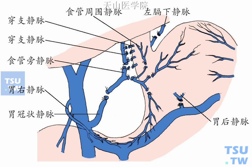 非选择性贲门周围血管离断术