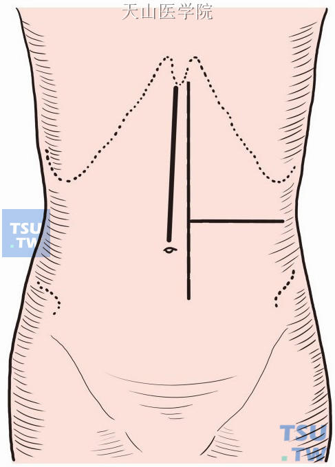 上腹正中切口或左上腹直肌切口，或左上腹“L”形切口