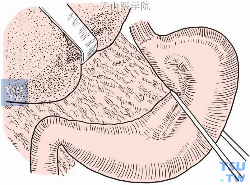 术者以示指尖从胃后壁顶向胃小弯，紧靠胃小弯的垂直部将小网膜戳孔伸出示指尖，用一条纱布带经戳孔绕胃体一周并收紧纱布带，将食管下端向左下牵拉