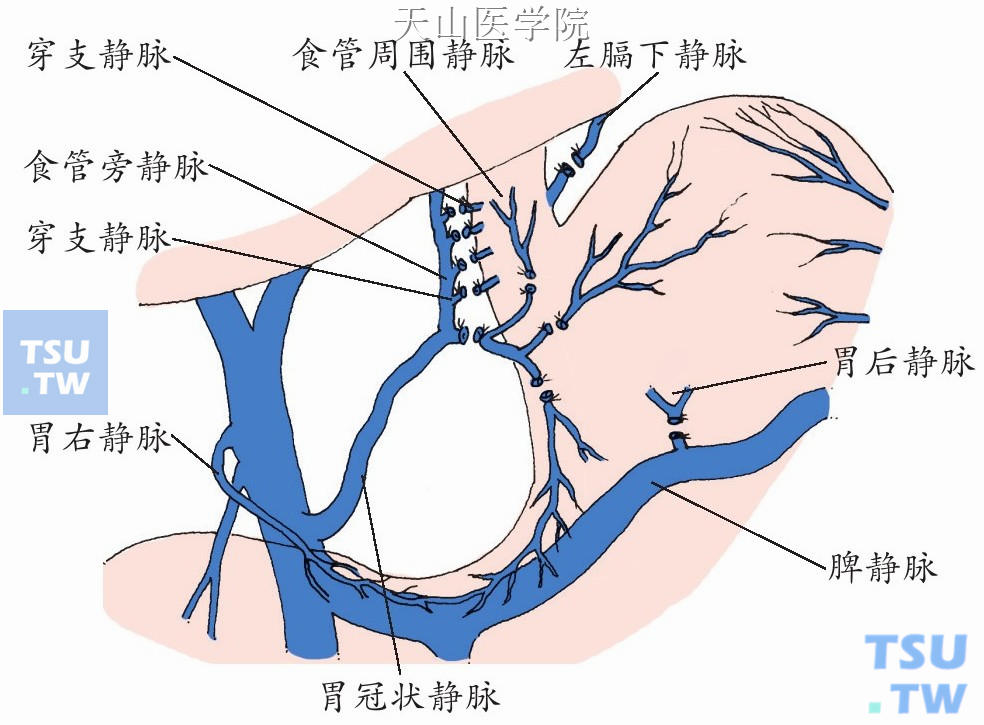 选择性贲门周围血管离断术范围示意图