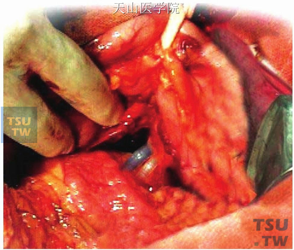 显露胃胰襞，是胃左动静脉的解剖学标志