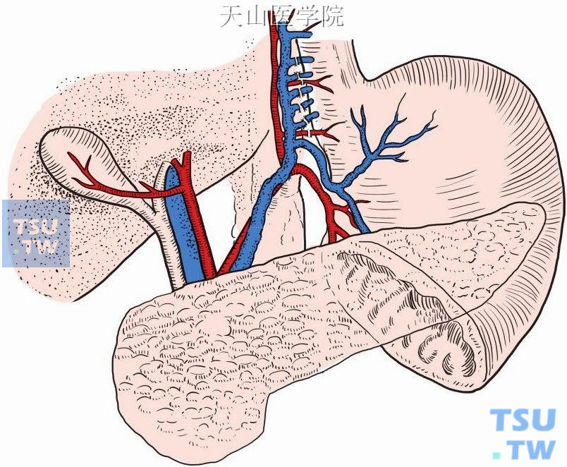 切断结扎胃支进入胃壁的分支（二）