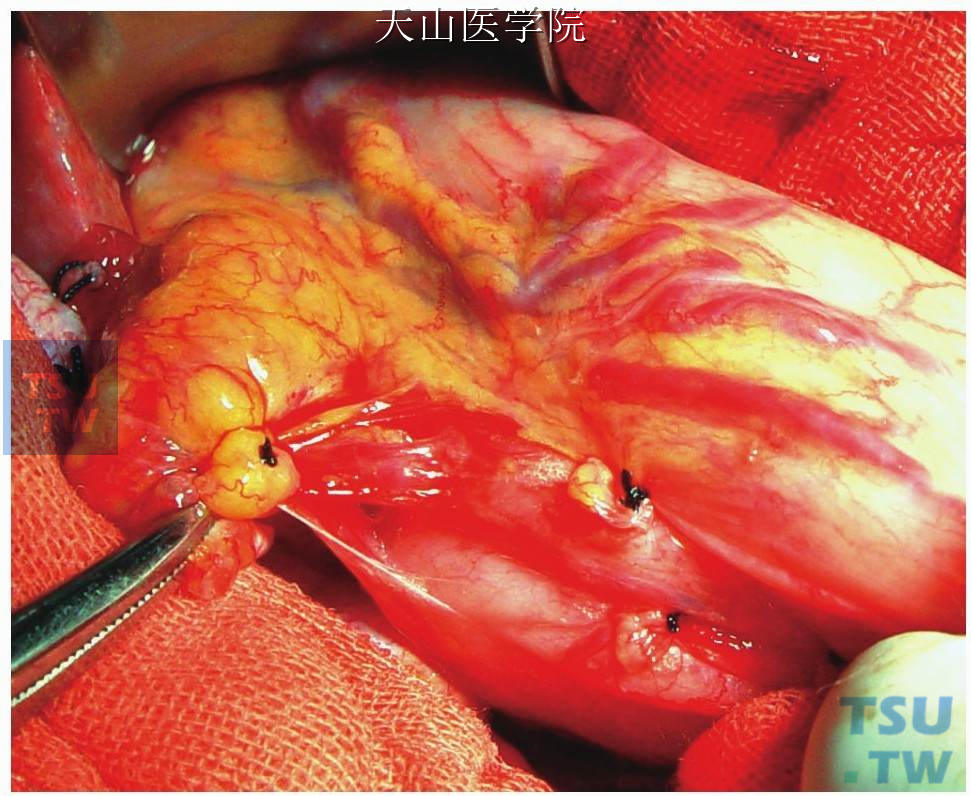 长弯血管钳钳夹胃左动（静）脉胃支的断端，向右前下方牵拉