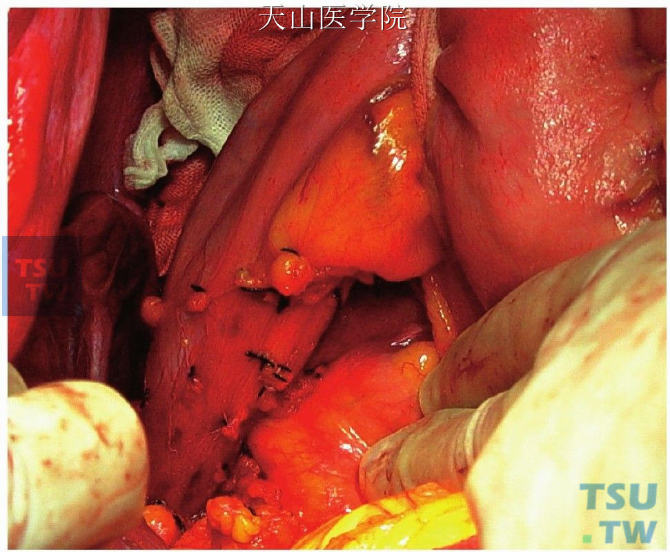 离断胃裸区和食管下端后壁的疏松组织及侧支血管