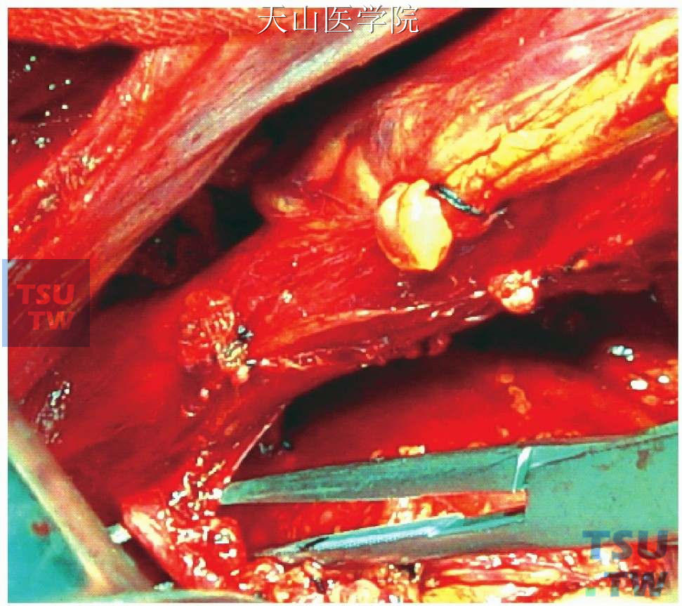 显露离断高位穿支静脉