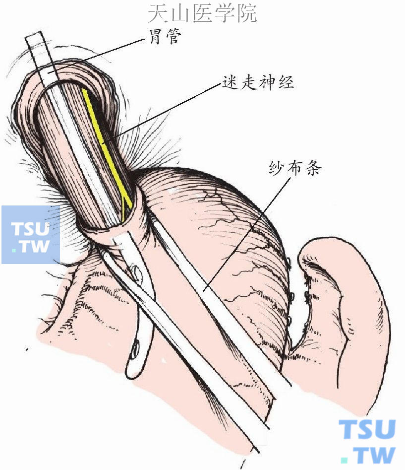 剪开膈下食管前浆膜，分离出贲门向左下方牵拉
