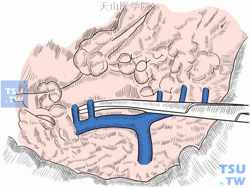 逐一离断垂直进入食管壁的穿支静脉