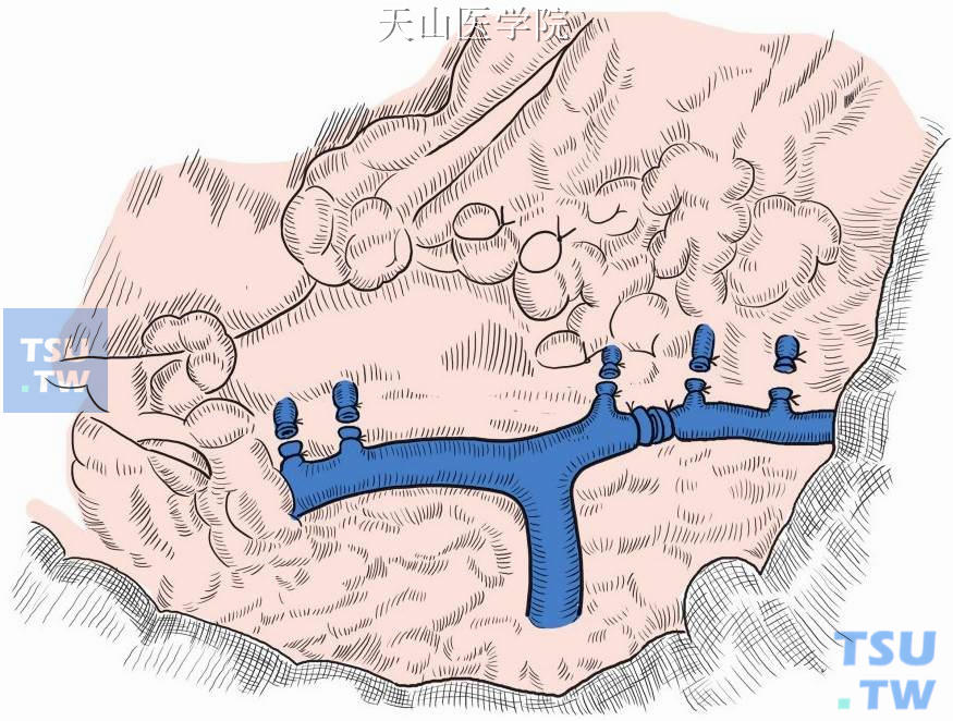 在胃底贲门区的逐步离断过程中，手术视野亦随之扩大，有利于寻找高位食管支和胃后静脉，一旦发生术中出血，亦易发现出血点